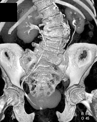 Ct Urogram - CTisus CT Scan