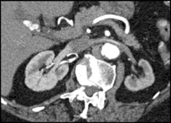 Decreased Density of Enhancement on Left Due to Ras - CTisus CT Scan