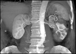 Renal Infarction - CTisus CT Scan