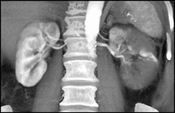 Renal Infarction - CTisus CT Scan