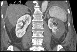 Renal Infarction - CTisus CT Scan