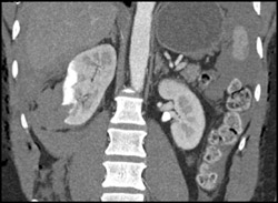 Renal Contusion and Perirenal Blood - Kidney Case Studies - CTisus CT ...