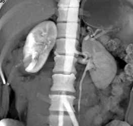 Renal Contusion - Kidney Case Studies - CTisus CT Scanning