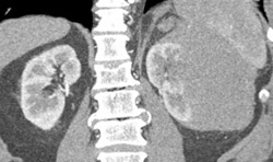 Renal Lymphoma - CTisus CT Scan