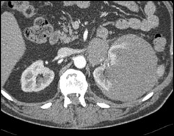 Renal Lymphoma- B Cell - CTisus CT Scan