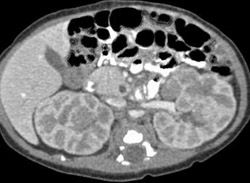 Beckwith-Weidemann Syndrome - CTisus CT Scan