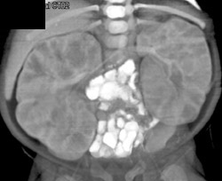 Nephroblastomatosis - CTisus CT Scan