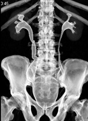 Ct Urogram - CTisus CT Scan