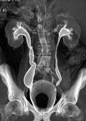 Ct Urogram - CTisus CT Scan