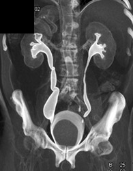 Ct Urogram - CTisus CT Scan