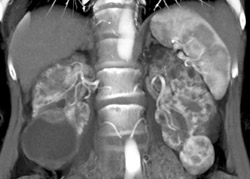 Renal Cell Carcinoma With Pck - CTisus CT Scan