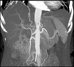 Vascular Right Renal Cell Carcinoma - CTisus CT Scan