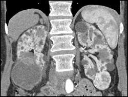 Multiple Renal Cell Carcinomas in A Patient With Pck Disease - CTisus CT Scan