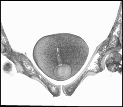 Foley in Bladder - CTisus CT Scan