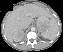 Acute Pyelonephritis - Right Kidney - CTisus CT Scan