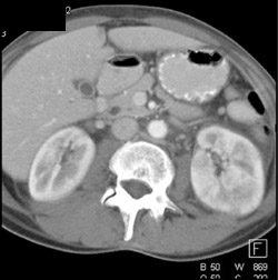 Focal Pyelonephritis Left Kidney - CTisus CT Scan