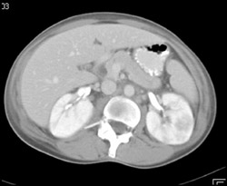 Acute Pyelonephritis With Focal Abscess - CTisus CT Scan