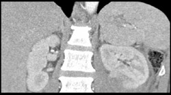 Perirenal Bleed - CTisus CT Scan