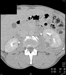 Perirenal Inflammation - CTisus CT Scan