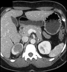 Renal Carcinoma Infiltrates the Right Kidney - CTisus CT Scan