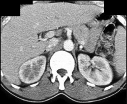 Acute Pyelonephritis - CTisus CT Scan