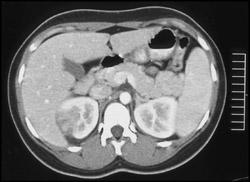 Acute Pyelonephritis - CTisus CT Scan