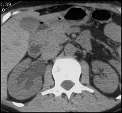 Stone Obstructing the Right Renal Pelvis - CTisus CT Scan