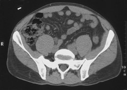 Stone in Right Ureter - CTisus CT Scan