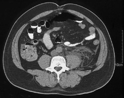 Inflammation in Course of Left Ureter - CTisus CT Scan