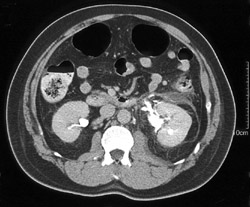 Pyelosinus Extravasation Left Kidney - CTisus CT Scan