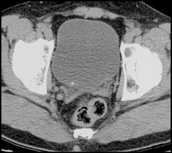 Stone in Bladder - CTisus CT Scan