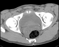 Bladder Cancer - CTisus CT Scan