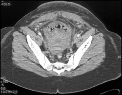 Abscess Involving Bladder Wall - CTisus CT Scan