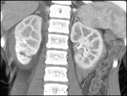 Renal Laceration With Perirenal Hematoma - CTisus CT Scan