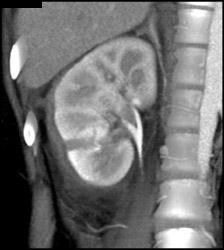 Renal Laceration - CTisus CT Scan