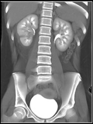 Renal Laceration - CTisus CT Scan