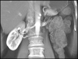 Multiple Renal Arteries on Left - CTisus CT Scan