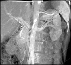 Crossing Vessel Causing Ureteropelvic Junction (UPJ) - CTisus CT Scan