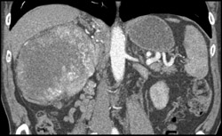 Renal Cell Carcinoma - CTisus CT Scan