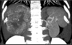 Renal Cell Carcinoma - CTisus CT Scan