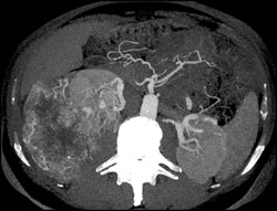 Renal Cell Carcinoma - CTisus CT Scan