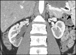 Poor Perfusion to the Lower Pole of the Right Kidney - CTisus CT Scan