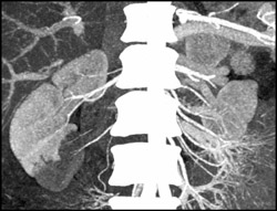 Poor Perfusion of the Right Kidney - CTisus CT Scan