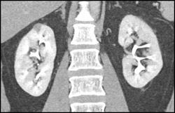 1 Cm Renal Cell Carcinoma - CTisus CT Scan