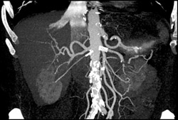 Stents in Renal Arteries - CTisus CT Scan