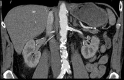 Open Stents in Renal Arteries - CTisus CT Scan