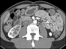 Poor Perfusion Right Kidney - CTisus CT Scan