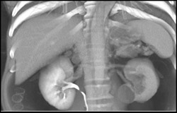 Decreased Enhancement Left Kidney - CTisus CT Scan