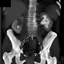 Bilateral Transitional Cell Cancer (TCC) - CTisus CT Scan