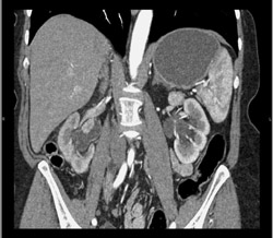 Multiple Transitional Cell Cancers (TCCs) - CTisus CT Scan